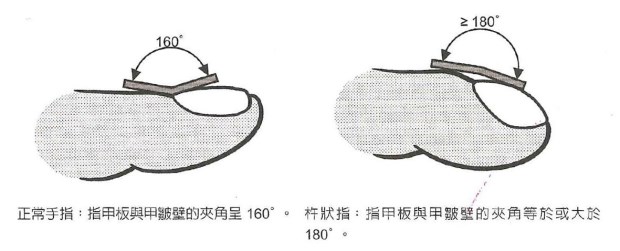 怎樣看出心臟有問(wèn)題 從手指、舌頭眼神測(cè)試