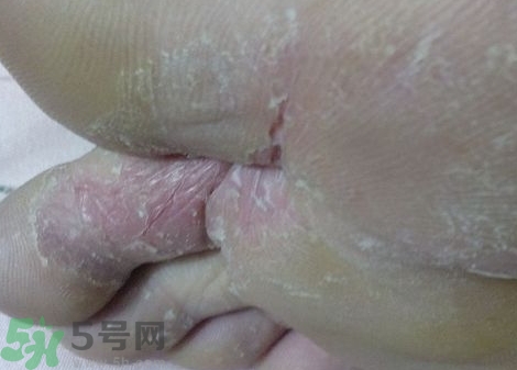 夏天腳脫皮用什么藥?夏天腳脫皮用什么泡腳?