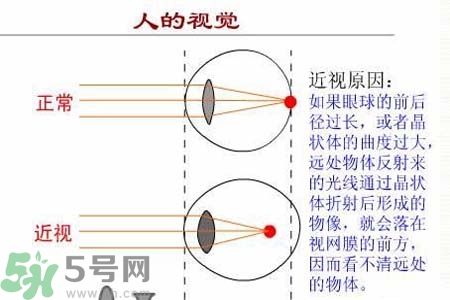 近視眼的發(fā)病因素？近視眼的并發(fā)癥有哪些？