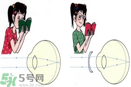 近視眼的發(fā)病因素？近視眼的并發(fā)癥有哪些？