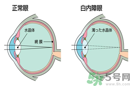 白內(nèi)障的發(fā)病因素是什么？白內(nèi)障并發(fā)癥有哪些？