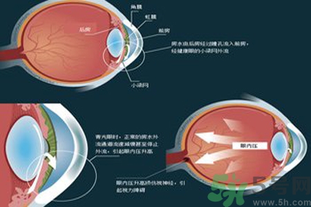 青光眼是什么？青光眼癥狀有什么？