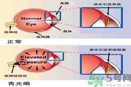 青光眼的護理措施有什么？青光眼的飲食護理有哪些？