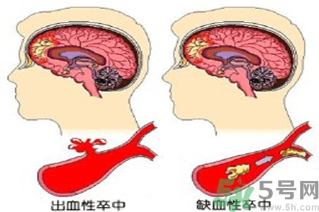 腦出血的治療方法是什么？腦出血可以用哪些藥物治療？