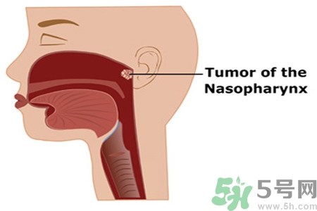 鼻咽癌的日常措施是什么？鼻咽癌注意的飲食有哪些？