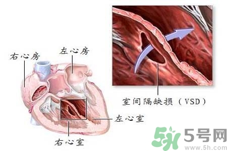 先天性心臟病是什么？先天性心臟病的癥狀有哪些？