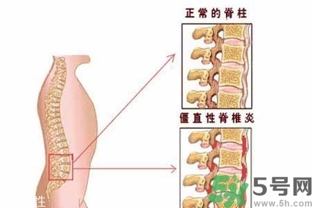 僵直性脊椎炎的癥狀有哪些？怎樣預(yù)防僵直性脊椎炎？