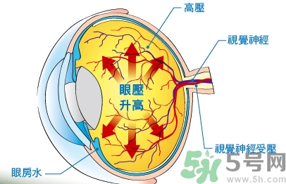 青光眼可以治愈嗎？青光眼怎樣治療？