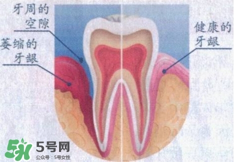 牙齦萎縮怎么辦？牙齦萎縮癥狀