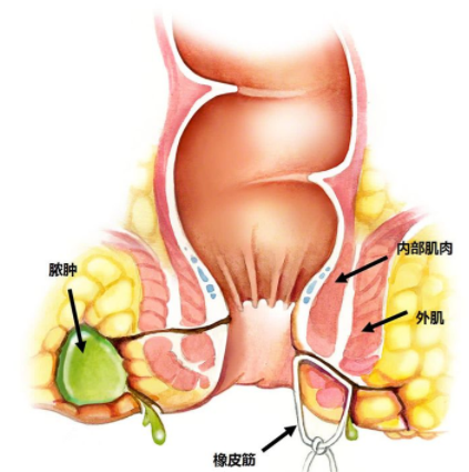 肛瘺非手術(shù)治療才可以嗎？手術(shù)是治療的關(guān)鍵途徑