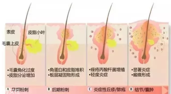 封閉性粉刺的發(fā)病機(jī)制是什么？角質(zhì)層太厚