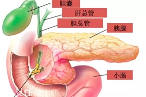 膽囊結(jié)石能用排石藥嗎?排出的石頭并非膽結(jié)石