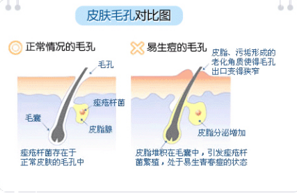 臉上長(zhǎng)痘痘怎么快速去除 如何一天之內(nèi)消除痘痘