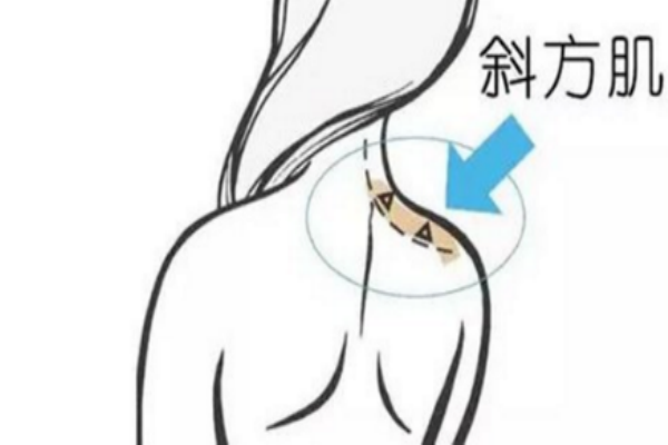 瘦肩針打哪個部位 主要針對斜方肌