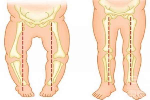 寶寶走路內(nèi)八字怎么辦 教你如何矯正