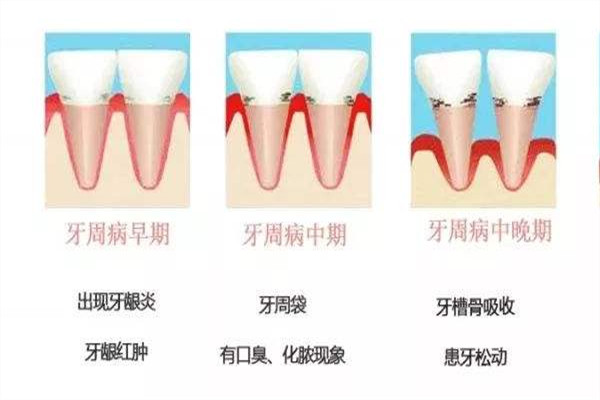 口腔健康的標準是什么 口腔健康管理