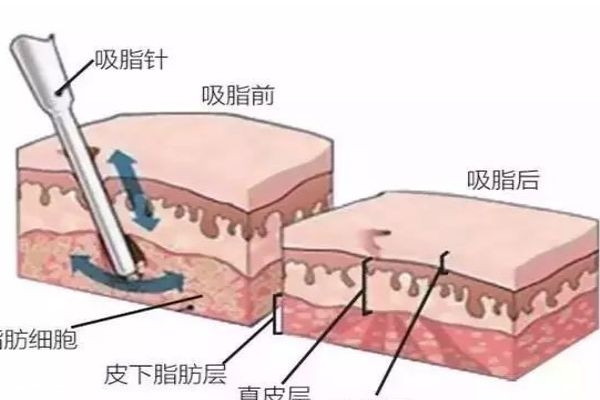 水動(dòng)力吸脂的工作原理是什么呢 水動(dòng)力吸脂多少錢一次呢