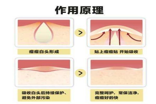 痘痘貼的工作原理有什么 痘痘貼應(yīng)該怎么用呢