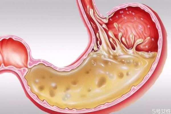 胃酸造成的原因什么 如何緩解胃酸