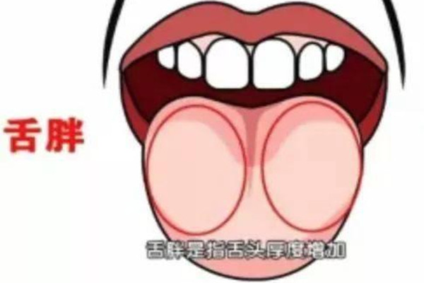 胖大舌是什么 什么情況下會(huì)出現(xiàn)胖大舌