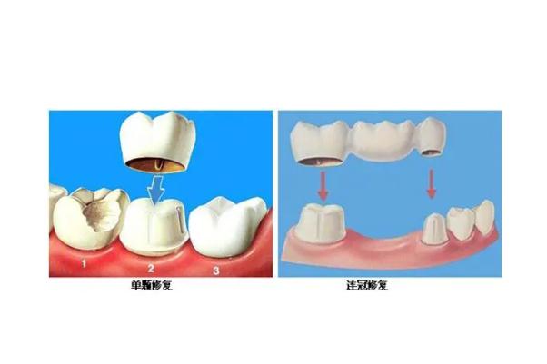 鑲牙是怎么固定的 鑲牙是固定的好還是活動(dòng)的好