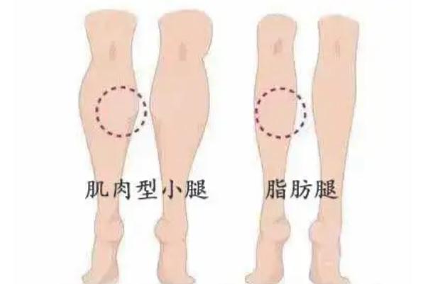 瘦腿針是瘦小腿還是大腿 瘦腿針打了能瘦大腿嗎