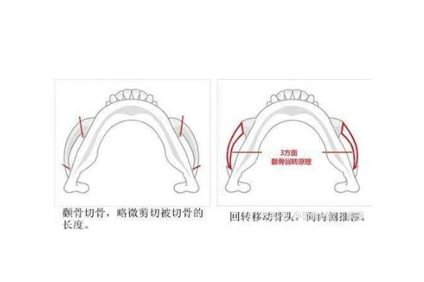 顴骨內(nèi)推的釘子需要取出嗎 顴骨內(nèi)推是幾級(jí)手術(shù)